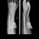 Non-union, fracture of ulna, shaft of distal ulna: X-ray - Plain radiograph